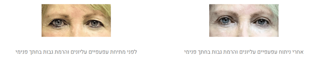 הרמת גבות לפני ואחרי