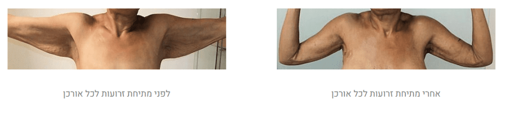 מתיחת זרועות לפני ואחרי