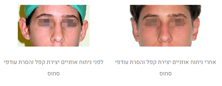 ניתוח הצמדת אוזניים לפני ואחרי