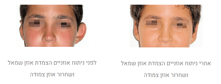 ניתוח הצמדת אוזניים לפני ואחרי
