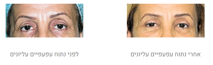 ניתוח עפעפיים לפני ואחרי