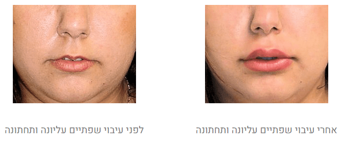 עיבוי שפתיים לפני ואחרי