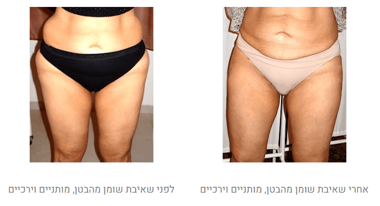 שאיבת שומן לפני ואחרי