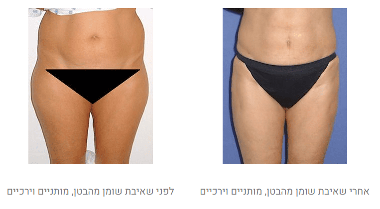 שאיבת שומן לפני ואחרי