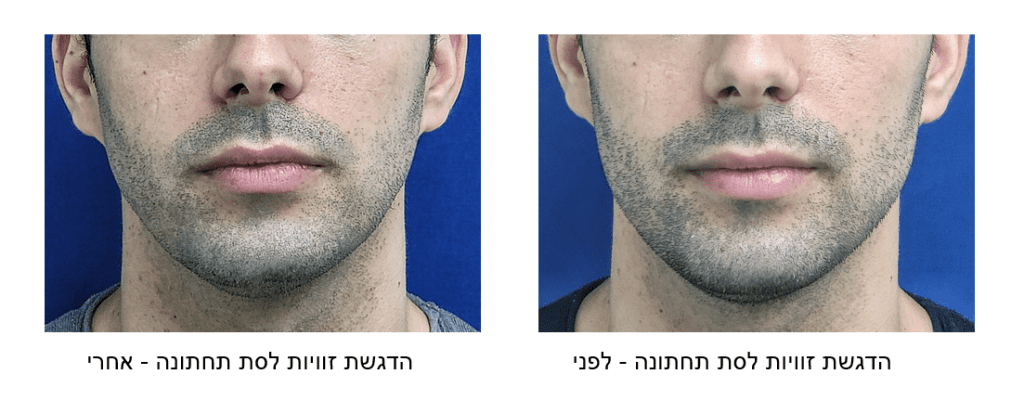 פיסול פנים לפני ואחרי