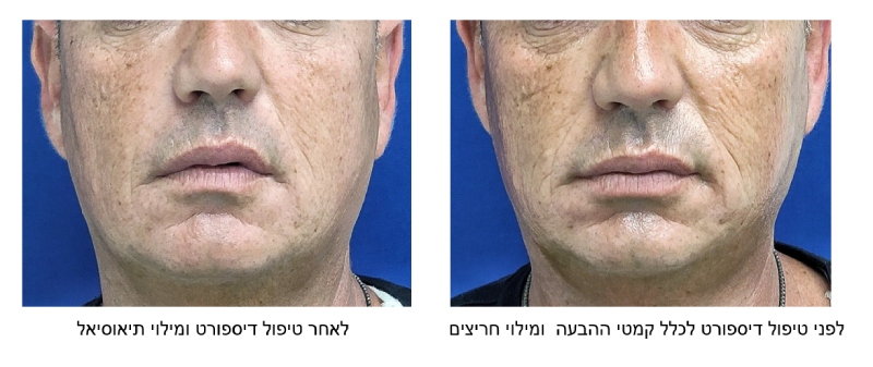 לפני ואחרי מיצוק עור הפנים