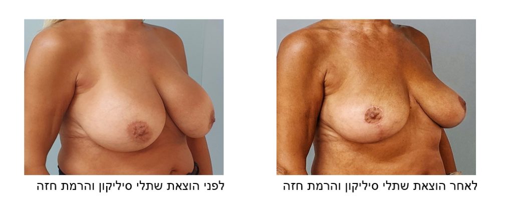 הוצאת שתלים לפני ואחרי