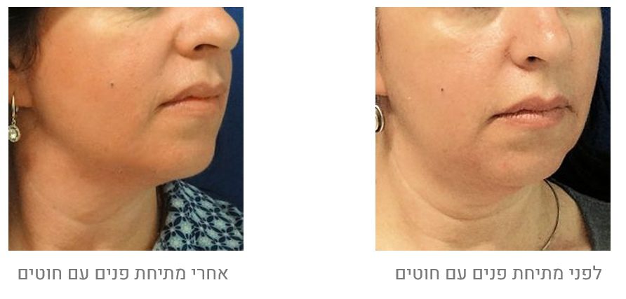 לפני ואחרי מתיחת פנים ללא ניתוח