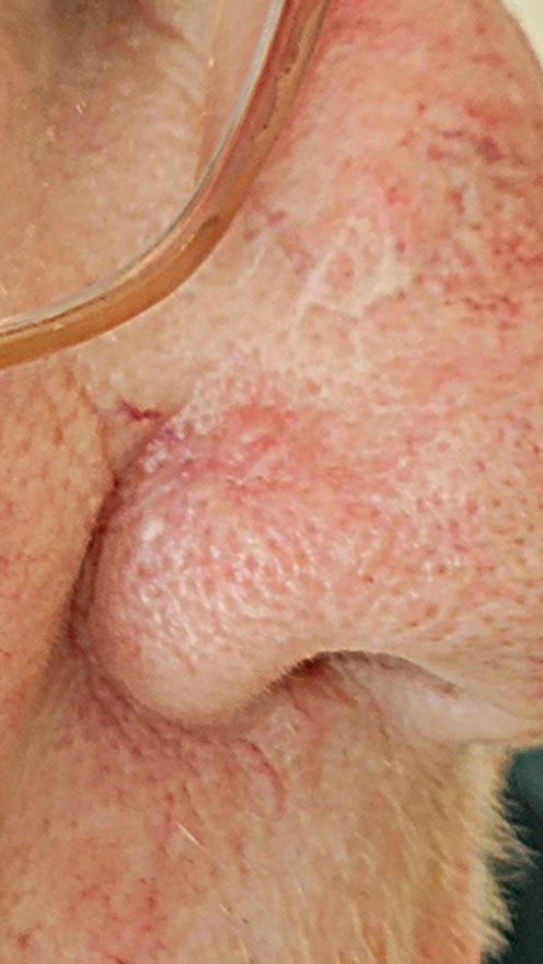 גידולי עור שפירים תמונות - Basal Cell Carcinoma