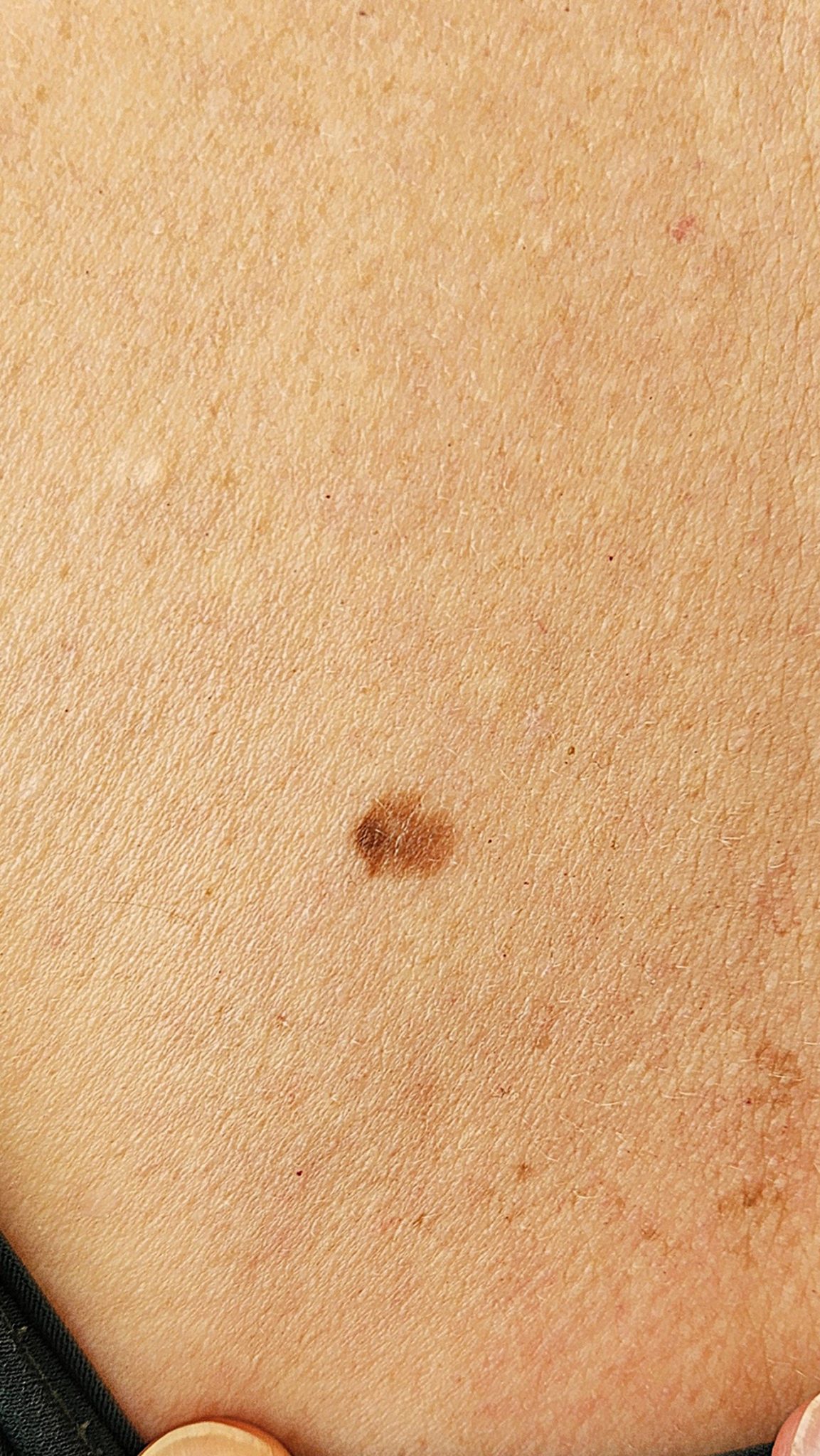 גידולי עור שפירים תמונות - Dysplastic Nevus