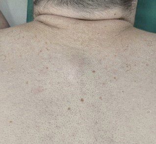 גידולי עור שפירים תמונות - Epidermal Cyst