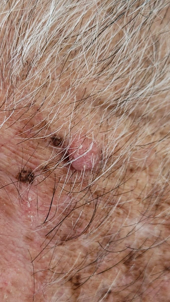גידולי עור שפירים תמונות - Intradermal Nevus