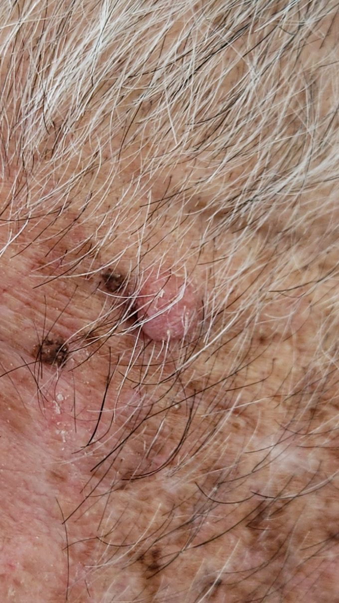 גידולי עור שפירים תמונות - Intradermal Nevus