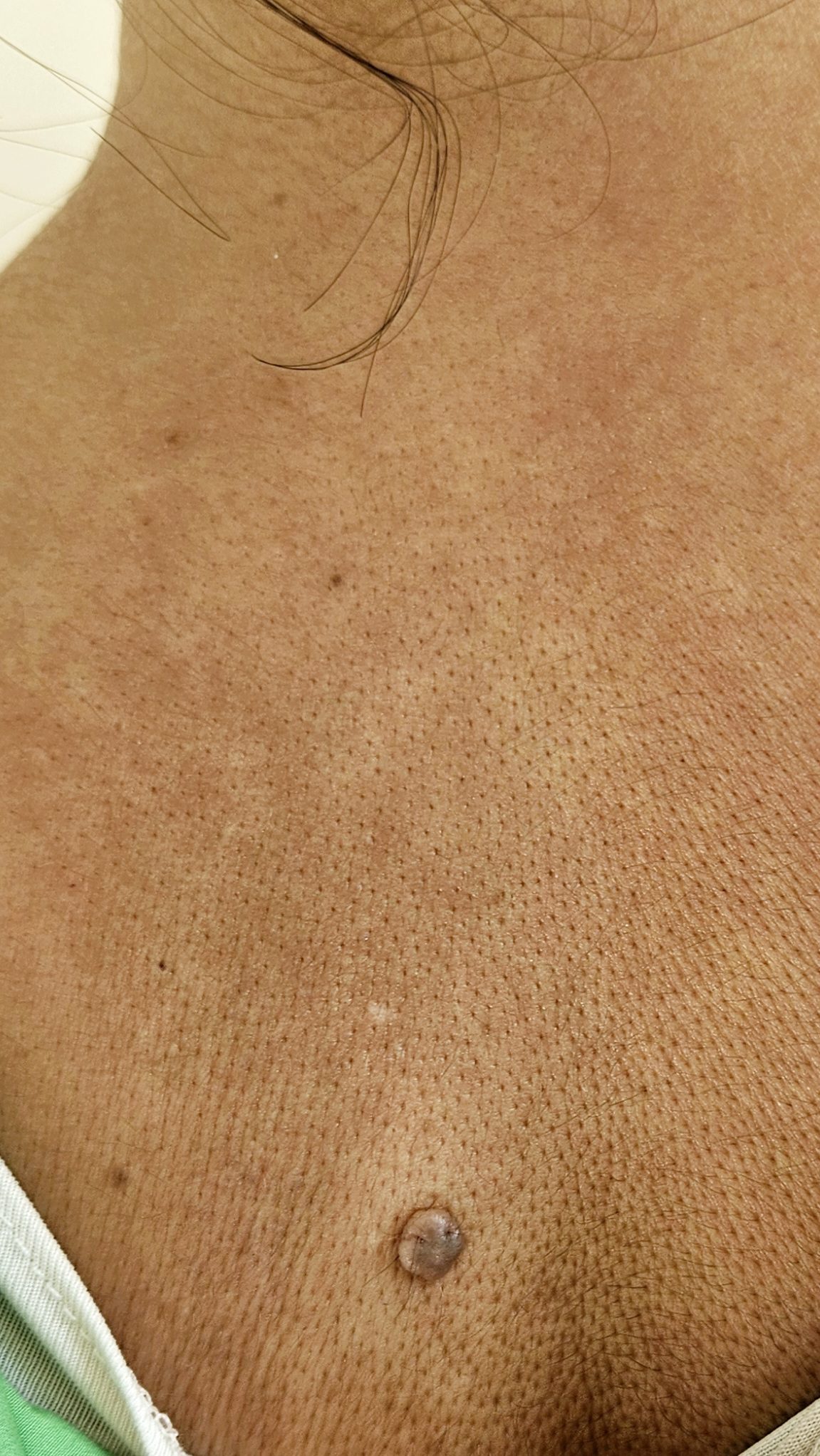 גידולי עור שפירים תמונות - Intradermal Nevus