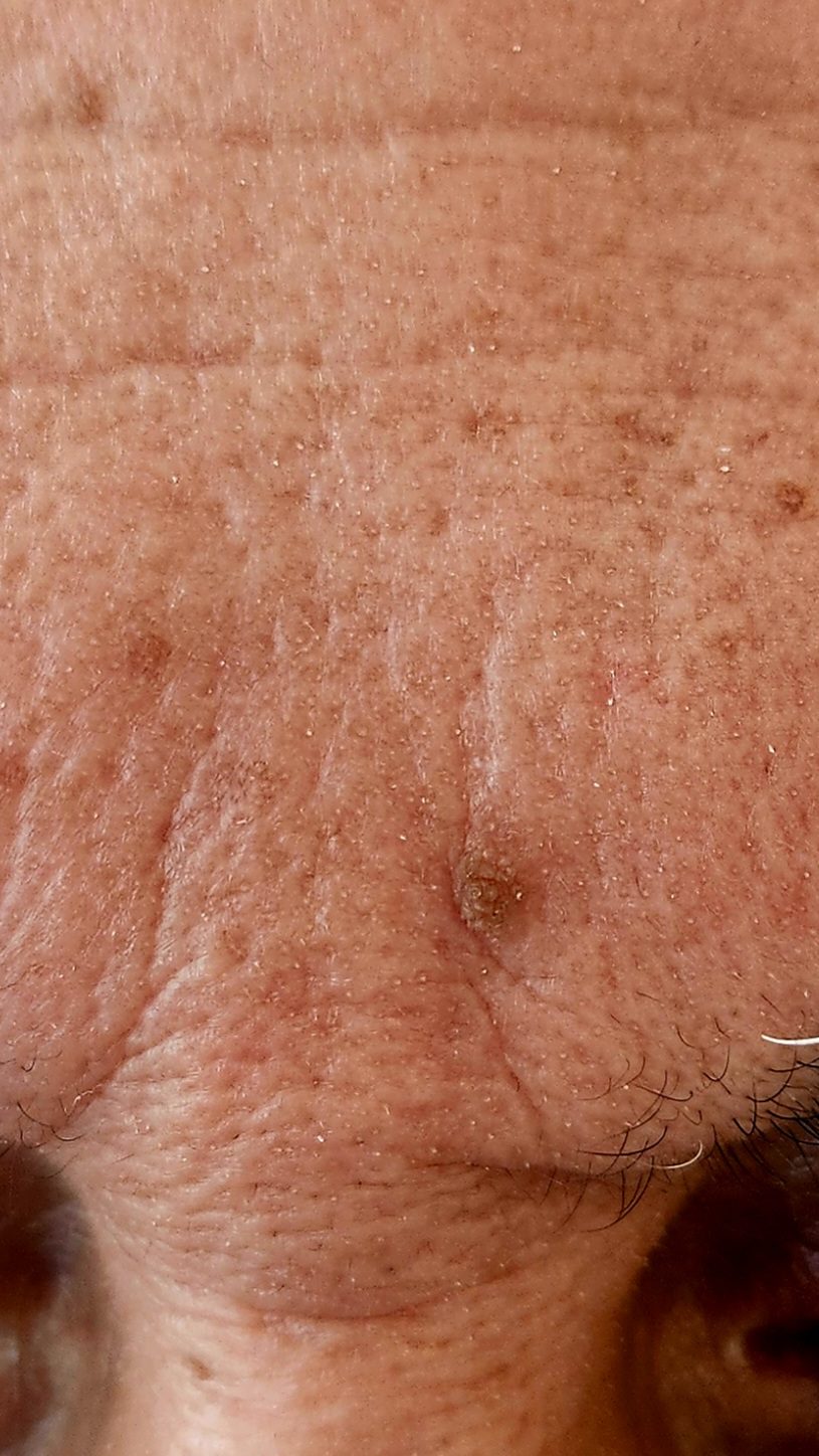 גידולי עור שפירים תמונות - Seborrheic Keratosis