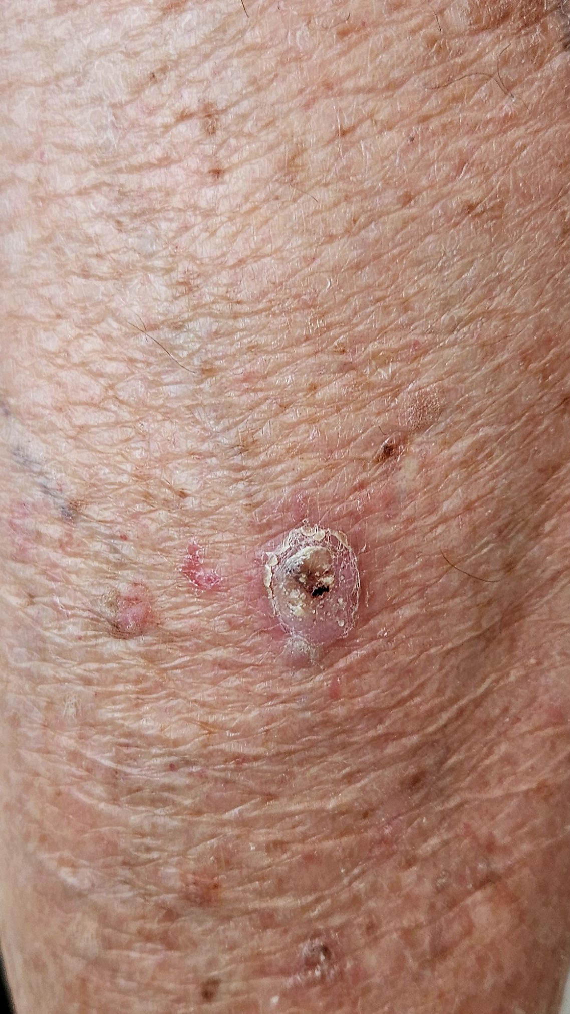 גידולי עור שפירים תמונות - Squamous Cell Carcinoma