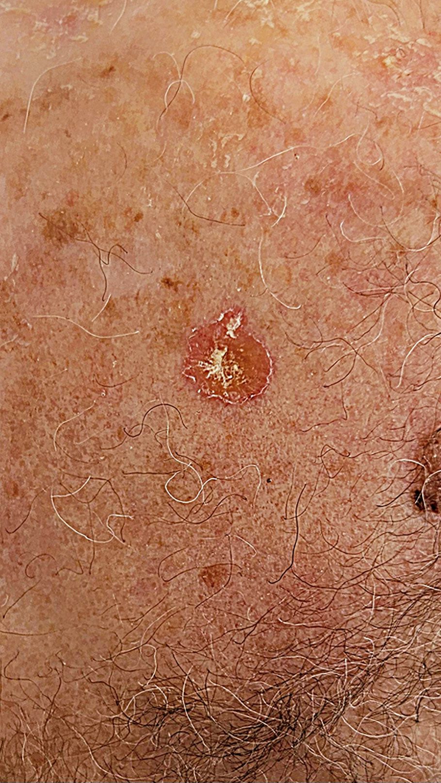 גידולי עור שפירים תמונות - Squamous Cell Carcinoma