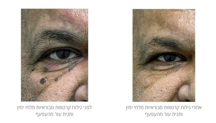 לפני ואחרי הסרת נגעים בעור