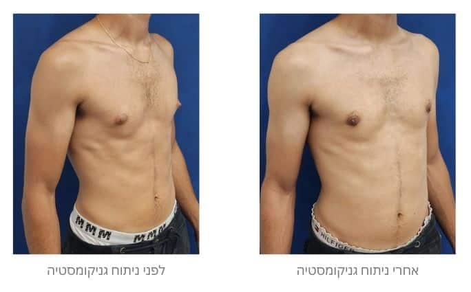 לפני ואחרי ניתוח גניקומסטיה