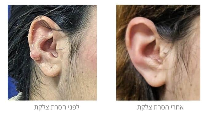 לפני ואחרי הסרת צלקת