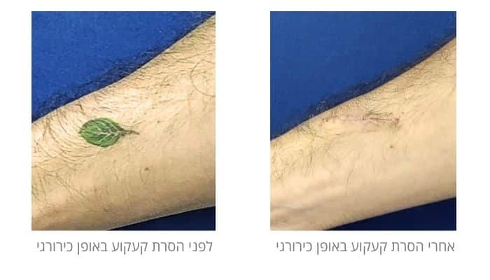 לפני ואחרי הסרת קעקוע באופן כירורגי
