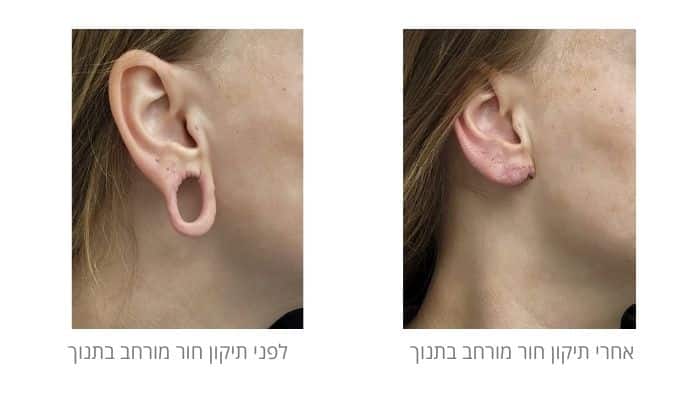 לפני ואחרי תיקון תנוך האוזן