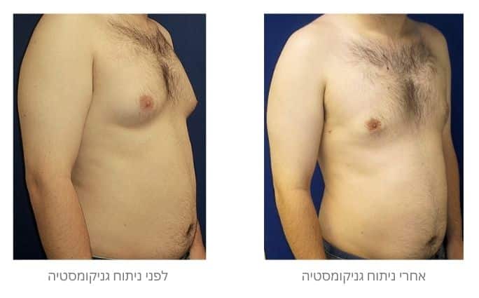 לפני ואחרי ניתוח גניקומסטיה
