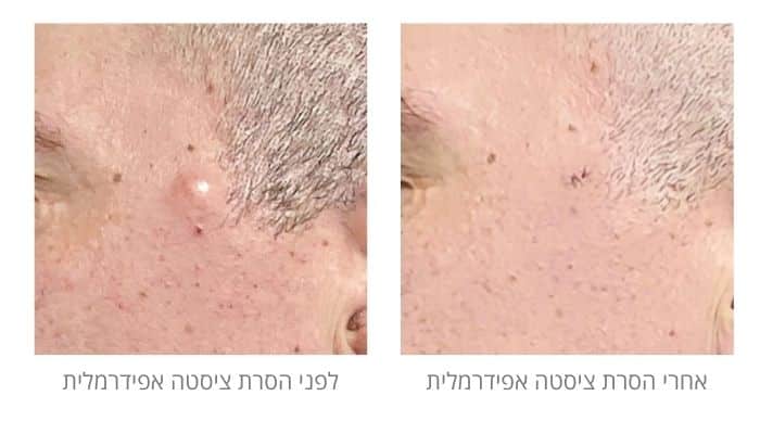 לפני ואחרי הסרת ציסטה אפידרמלית