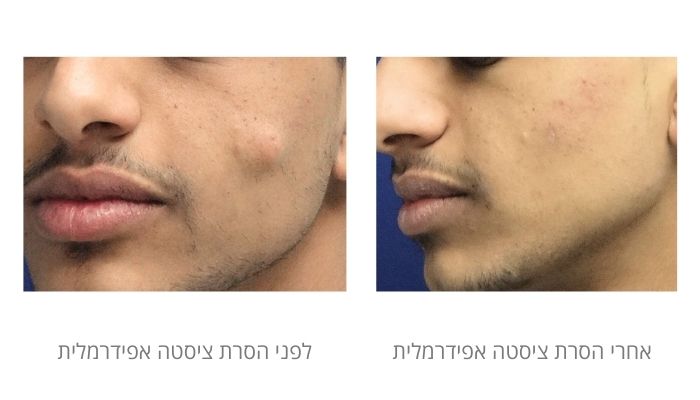 לפני ואחרי הסרת ציסטה אפידרמלית