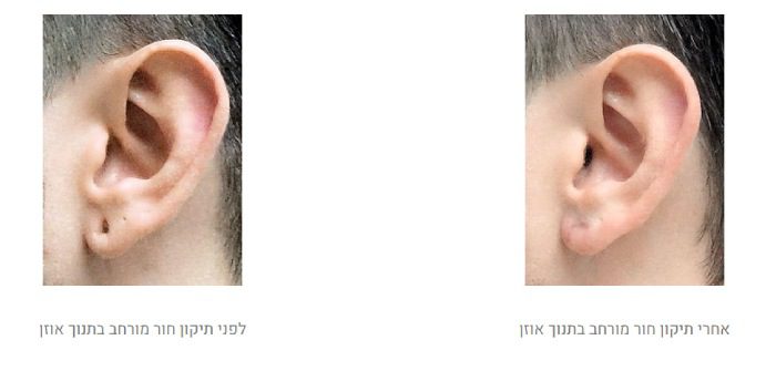 לפני ואחרי תיקון תנוך האוזן