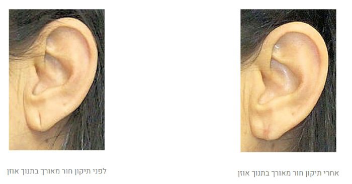 לפני ואחרי תיקון תנוך האוזן
