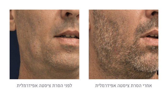 לפני ואחרי הסרת ציסטה אפידרמלית