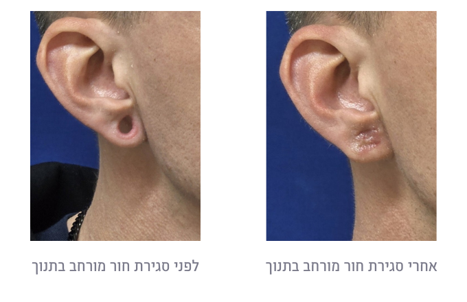 לפני ואחרי סגירת חור מורחב בתנוך