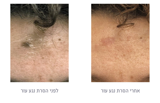 לפני ואחרי הסרת נגע עור