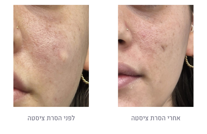 לפני ואחרי הסרת ציסטה
