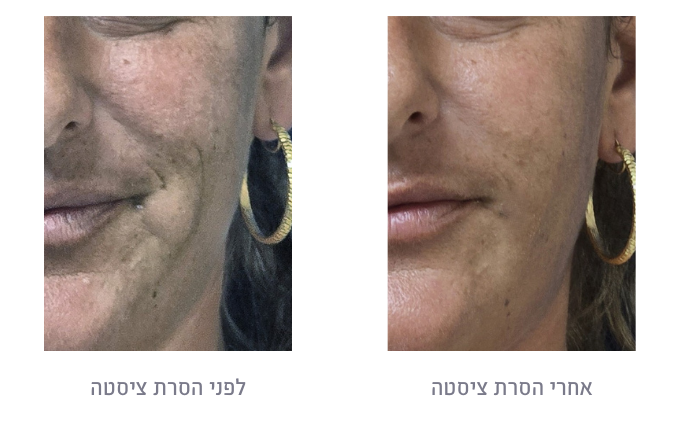 לפני ואחרי הסרת ציסטה