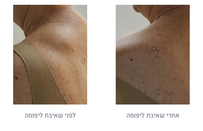 לפני ואחרי שאיבת ליפומה