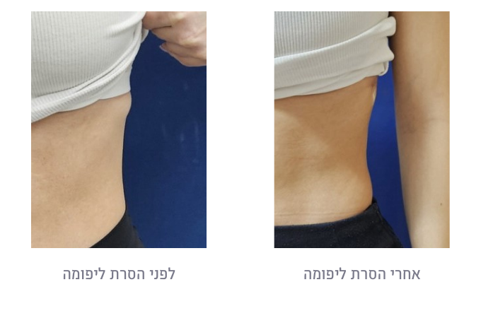 לפני ואחרי הסרת ליפומה