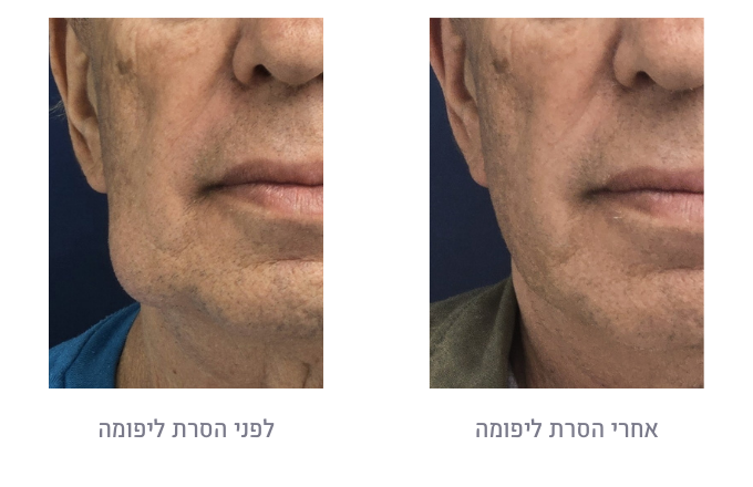 לפני ואחרי הסרת ליפומה