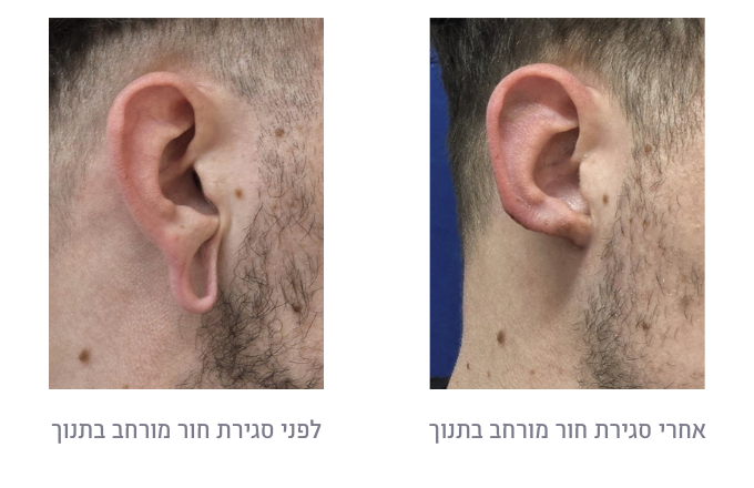 לפני ואחרי סגירת חור מורחב בתנוך