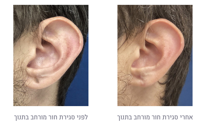 לפני ואחרי סגירת חור מורחב בתנוך