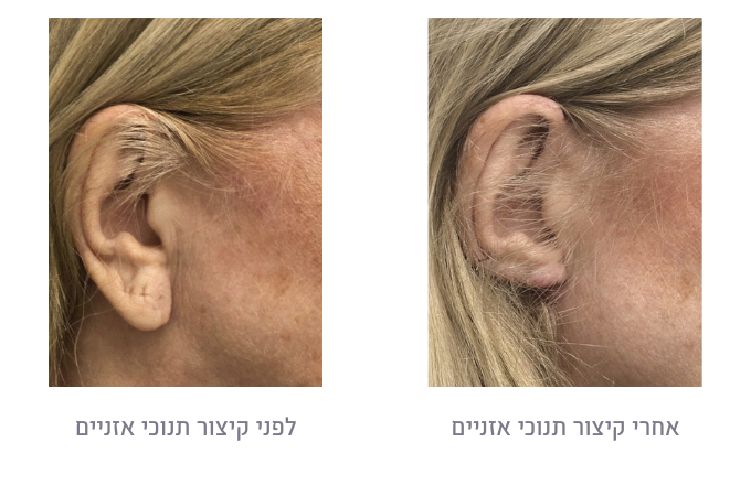 לפני ואחרי קיצור תנוכי אזניים