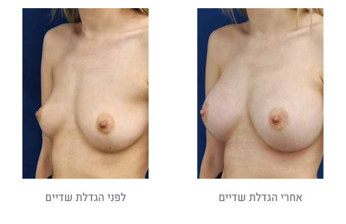 לפני ואחרי הגדלת חזה