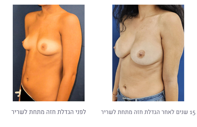 לפני ואחרי הגדלת חזה