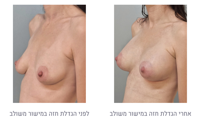 לפני ואחרי הגדלת חזה