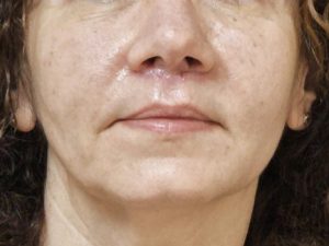 אחרי הרמת שפה עליונה