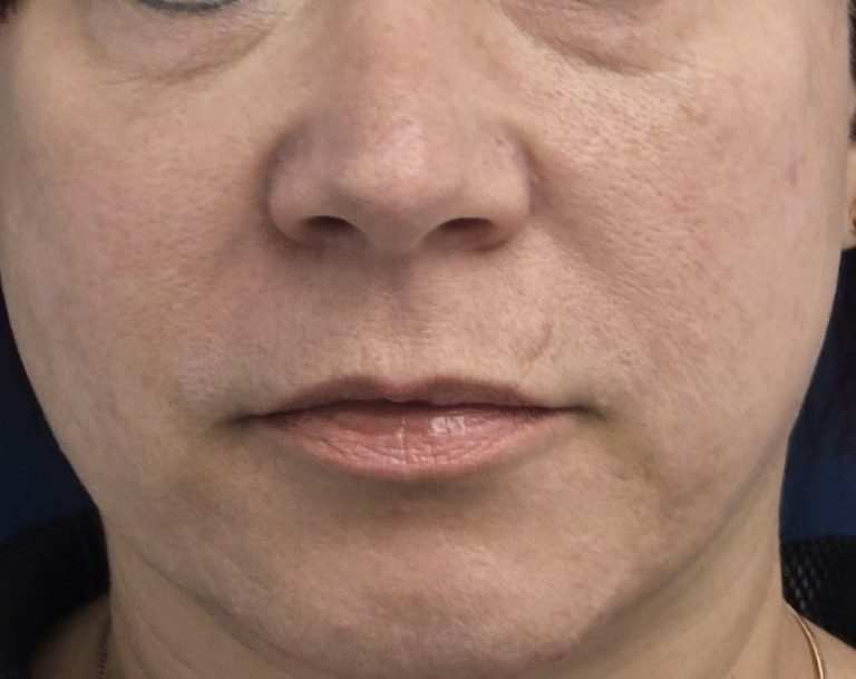 לפני הרמת שפה עליונה