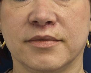 אחרי הרמת שפה עליונה